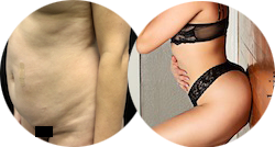 tummy tuck