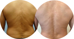 liposuction