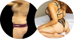 vaser liposuction