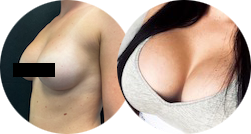 liposuction