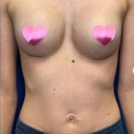 Breast Augmentation Before & After Patient #167
