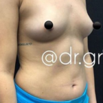 Breast Augmentation Before & After Patient #178