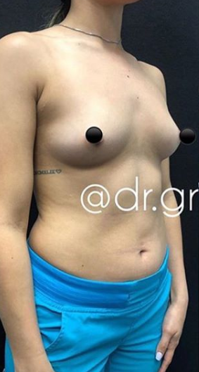 Breast Augmentation Before & After Patient #178