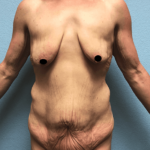 Breast Lift Before & After Patient #181
