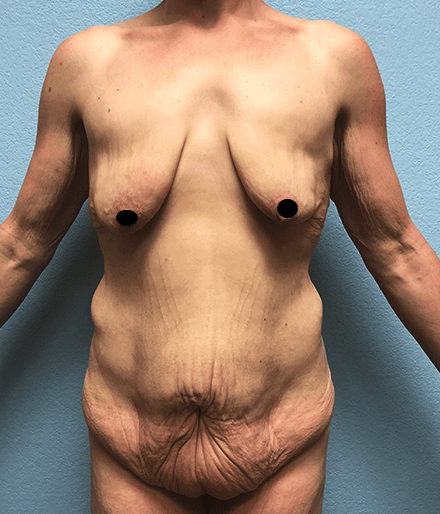 Breast Lift Before & After Patient #181