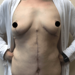 Breast Lift Before & After Patient #181