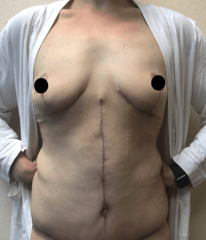 Breast Lift Before & After Patient #181