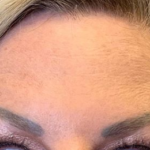 Botox Before & After Patient #67