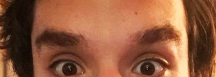 Botox Before & After Patient #70