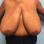 Breast Reduction Before & After Patient #187