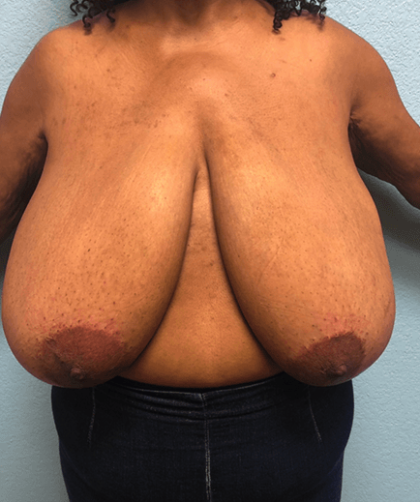 Breast Reduction Before & After Patient #187