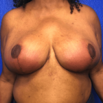 Breast Reduction Before & After Patient #187