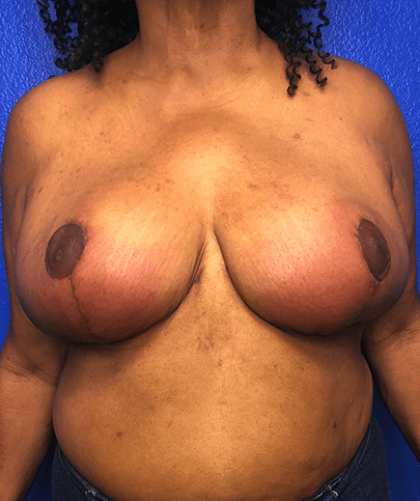 Breast Reduction Before & After Patient #187