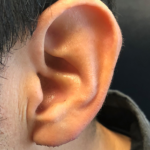 Earlobe Revision Before & After Patient #81