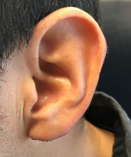 Earlobe Revision Before & After Patient #81