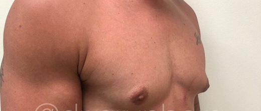 Liposuction Before & After Patient #196