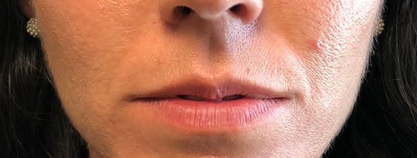 Juvéderm Before & After Patient #99