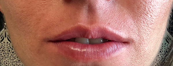 Juvéderm Before & After Patient #99