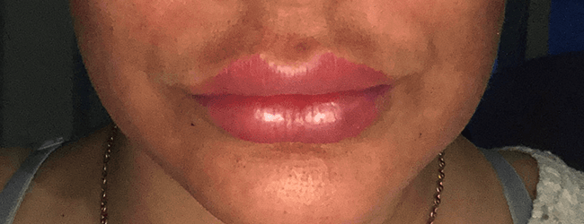 Juvéderm Before & After Patient #106