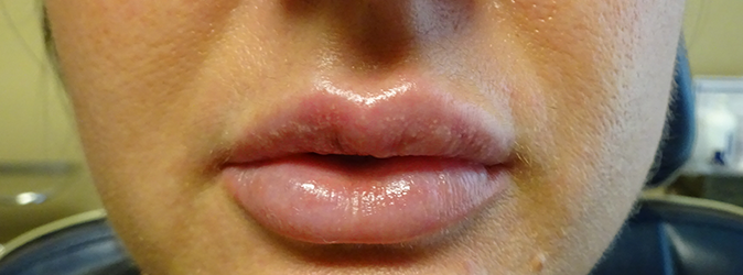 Juvéderm Before & After Patient #115