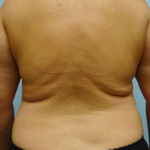 Liposuction Before & After Patient #205