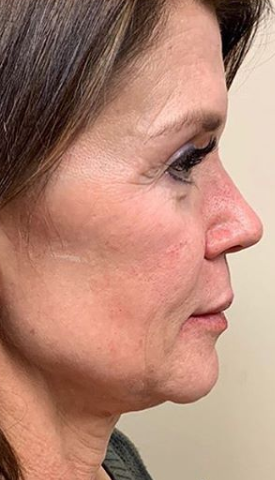 Morpheous8 Before & After Patient #131