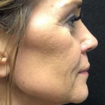 Morpheous8 Before & After Patient #131