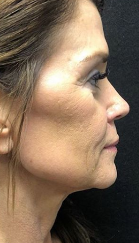 Morpheous8 Before & After Patient #131