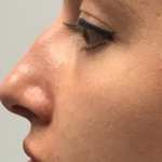Non-surgical Rhinoplasty Before & After Patient #143