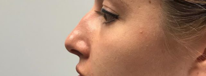 Non-surgical Rhinoplasty Before & After Patient #143