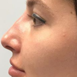 Non-surgical Rhinoplasty Before & After Patient #143