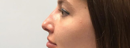 Non-surgical Rhinoplasty Before & After Patient #143