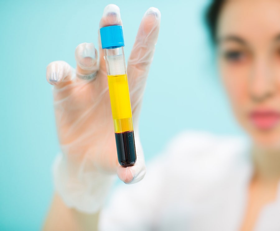 Platelet Rich Plasma (PRP)