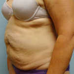 Tummy Tuck Before & After Patient #208