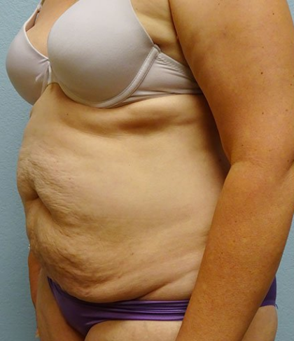 Tummy Tuck Before & After Patient #208
