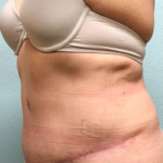 Tummy Tuck Before & After Patient #208