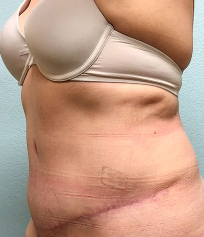 Tummy Tuck Before & After Patient #208