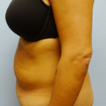 Tummy Tuck Before & After Patient #211