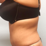 Tummy Tuck Before & After Patient #211