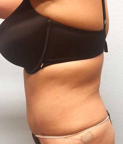 Tummy Tuck Before & After Patient #211