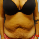 Tummy Tuck Before & After Patient #211