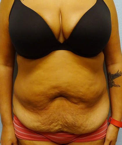 Tummy Tuck Before & After Patient #211