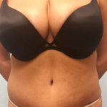 Tummy Tuck Before & After Patient #211