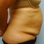 Tummy Tuck Before & After Patient #216