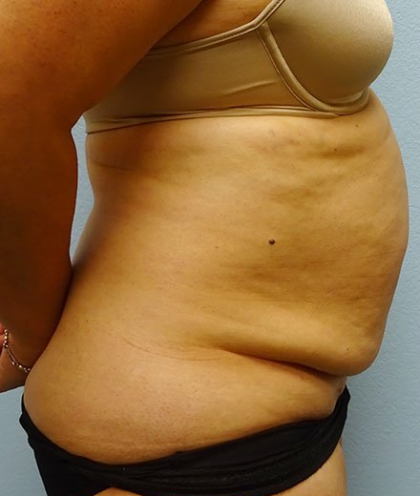 Tummy Tuck Before & After Patient #216