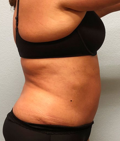 Tummy Tuck Before & After Patient #216