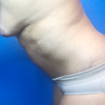 Tummy Tuck Before & After Patient #219