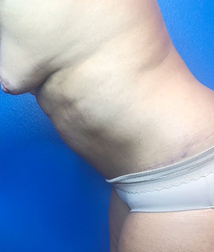 Tummy Tuck Before & After Patient #219