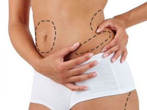 Liposuction