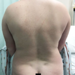 Vaser Liposuction Before & After Patient #228